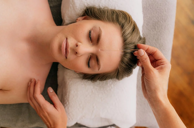 acupuncture